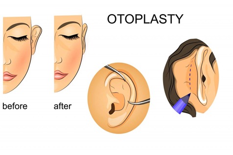 Ear surgery