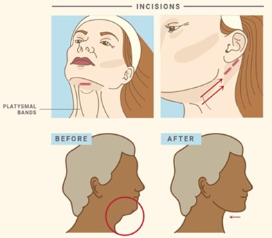 Neck lift surgery