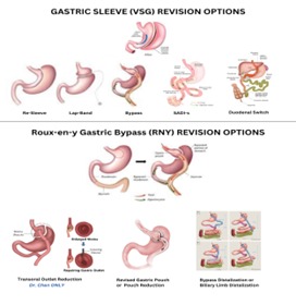 Revisional Bariatric Surgery
