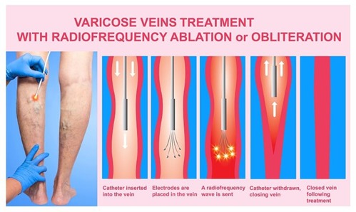 Varicose Veins