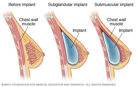 Breast Lift