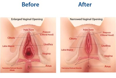 Vaginoplasty