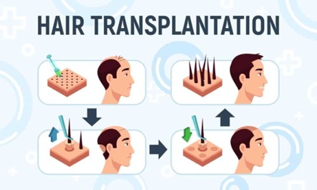 Hair Transplantation