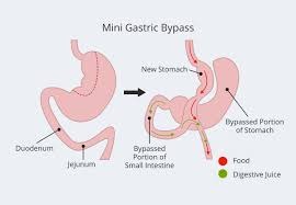Mini Gastric Bypass