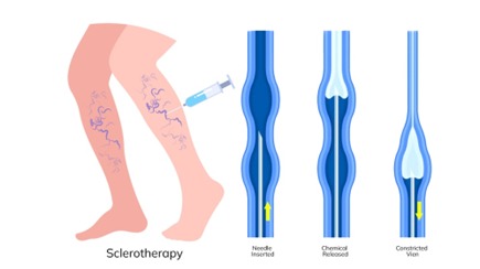 Sclerotherapy